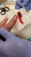 Needle and Thread (like pulling out stitches with a fork)